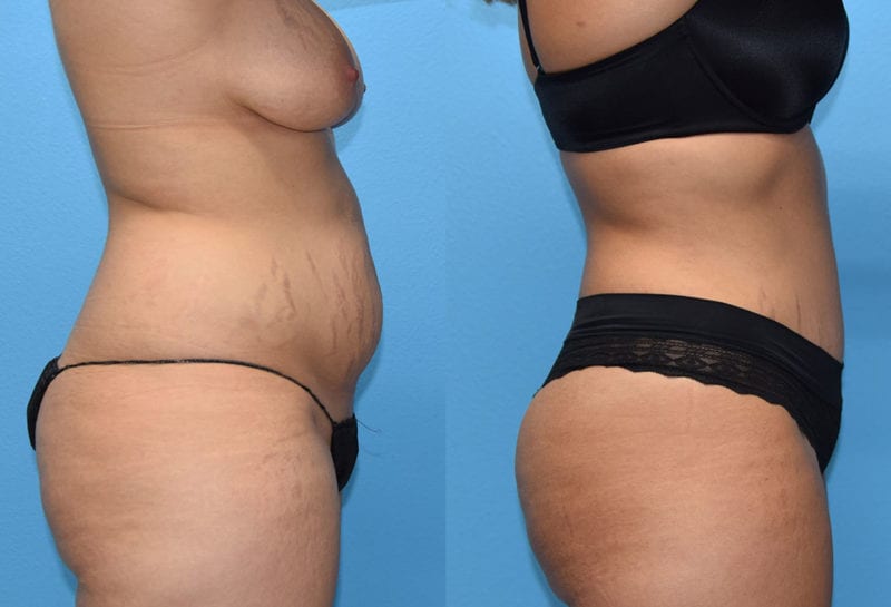 Tummy tuck results by Dr. Maningas at Maningas Cosmetic Surgery in Joplin, MO