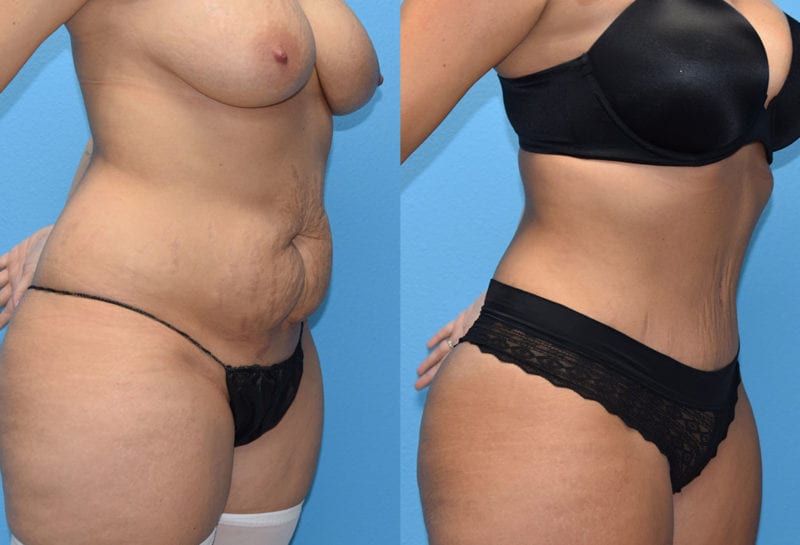 Tummy tuck results by Dr. Maningas at Maningas Cosmetic Surgery in Joplin, MO