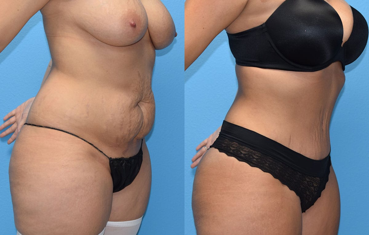 Tummy tuck results by Dr. Maningas at Maningas Cosmetic Surgery in Joplin, MO