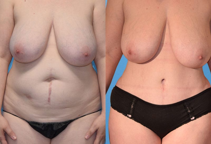 Tummy tuck results by Dr. Maningas at Maningas Cosmetic Surgery in Joplin, MO