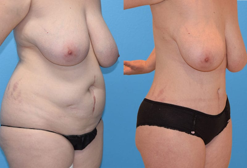 Tummy tuck results by Dr. Maningas at Maningas Cosmetic Surgery in Joplin, MO