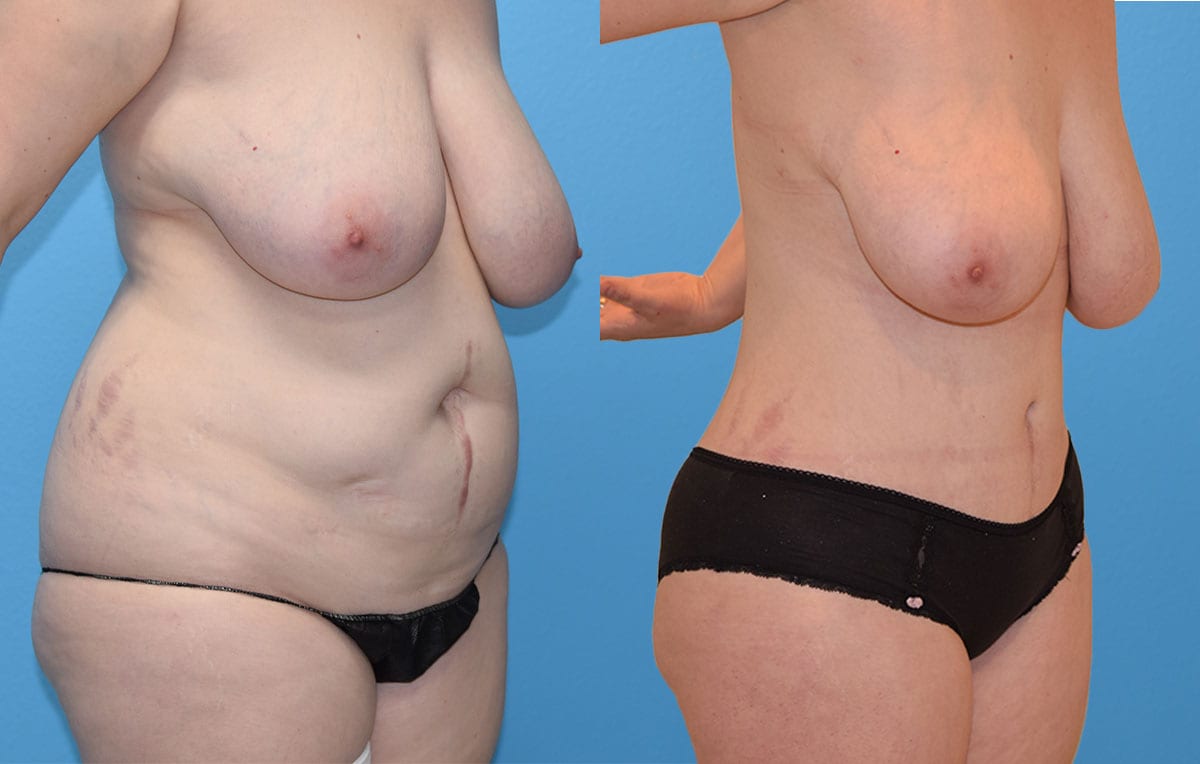 Tummy tuck results by Dr. Maningas at Maningas Cosmetic Surgery in Joplin, MO