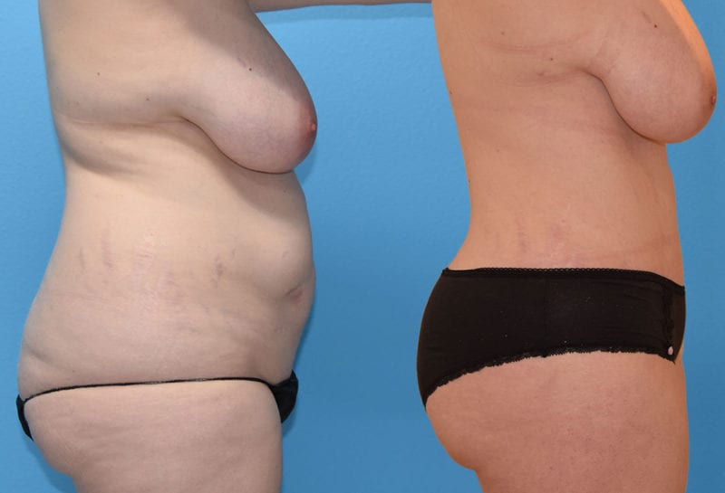 Tummy tuck results by Dr. Maningas at Maningas Cosmetic Surgery in Joplin, MO