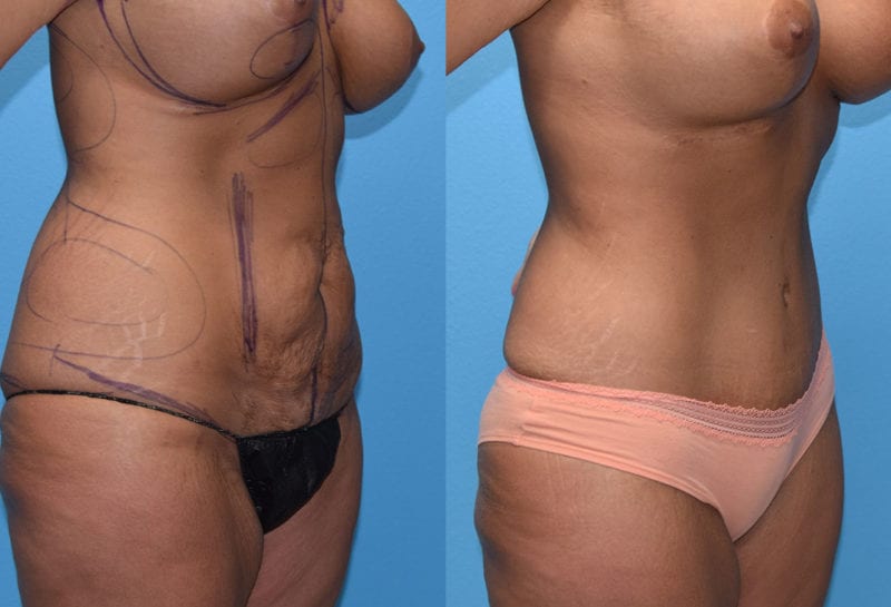 Tummy tuck results by Dr. Maningas at Maningas Cosmetic Surgery in Joplin, MO