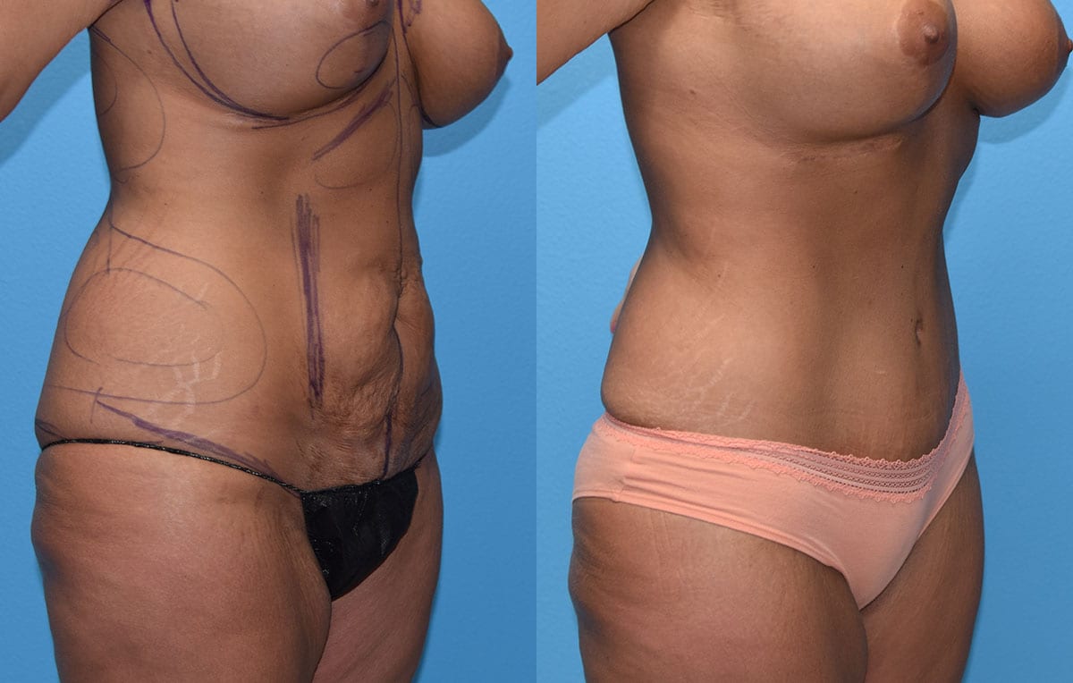 Tummy tuck results by Dr. Maningas at Maningas Cosmetic Surgery in Joplin, MO