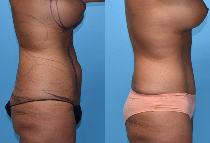 Tummy tuck results by Dr. Maningas at Maningas Cosmetic Surgery in Joplin, MO