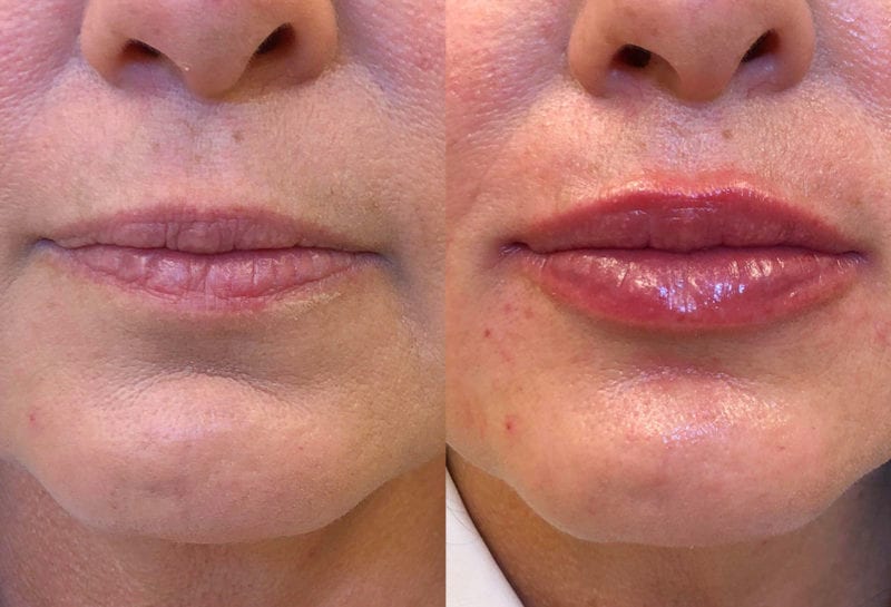 Lip Filler in Joplin, MO at Maningas Cosmetics Surgery