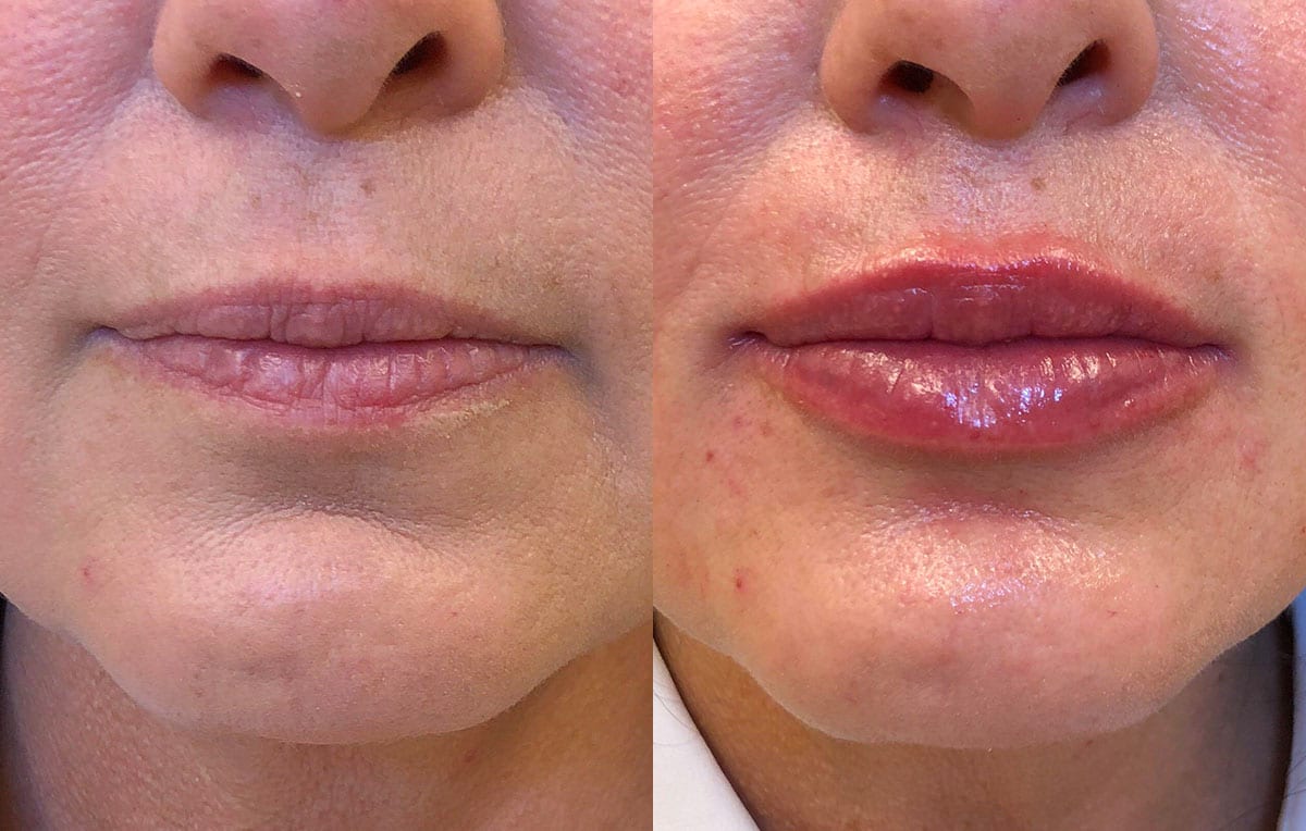 Lip Filler in Joplin, MO at Maningas Cosmetics Surgery