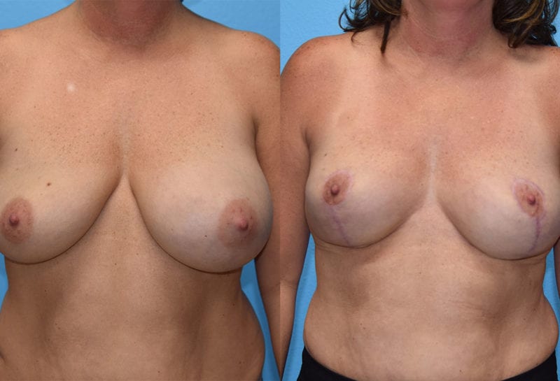 breast reduction results by Dr. Maningas as Maningas Cosmetic Surgery