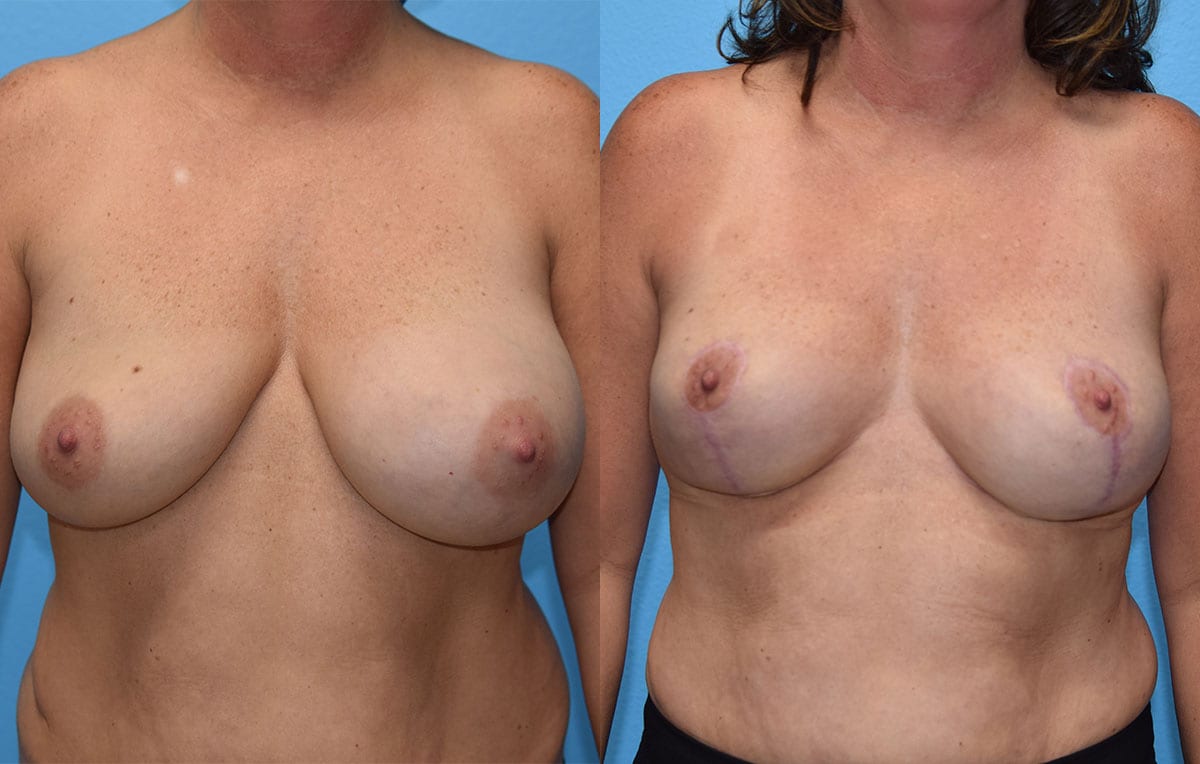 breast reduction results by Dr. Maningas as Maningas Cosmetic Surgery