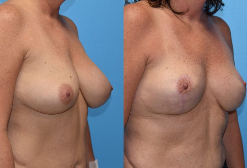 breast reduction results by Dr. Maningas as Maningas Cosmetic Surgery