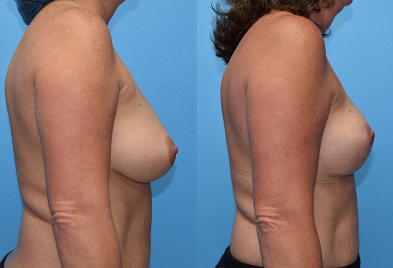 breast reduction results by Dr. Maningas as Maningas Cosmetic Surgery