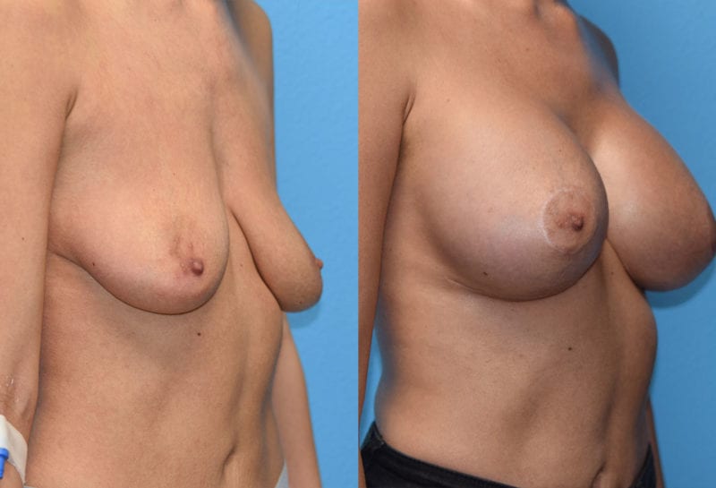 Breast Lift with Implant results by Dr. Maningas at Maningas Cosmetic Surgery in Missouri and Arkansas