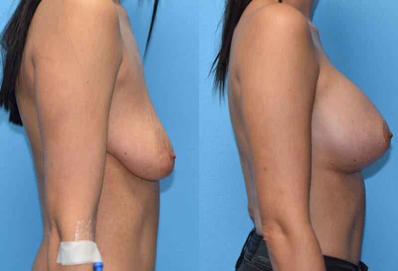 Breast Lift with Implant results by Dr. Maningas at Maningas Cosmetic Surgery in Missouri and Arkansas