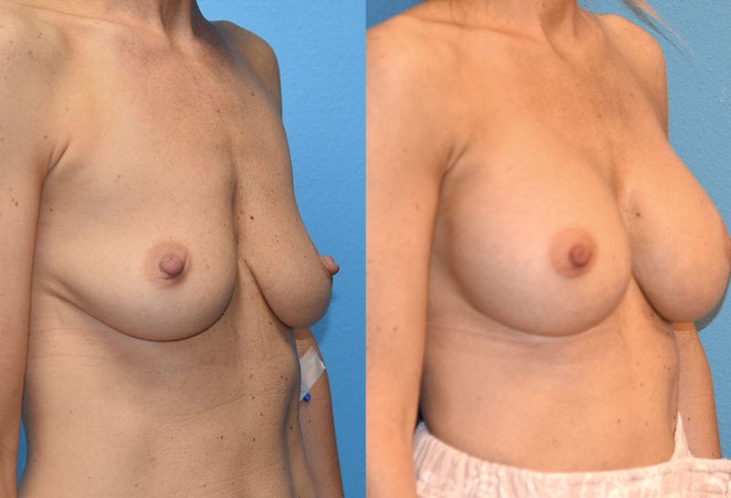 breast augmentation results by dr. maningas at maningas cosmetic surgery in joplin, mo