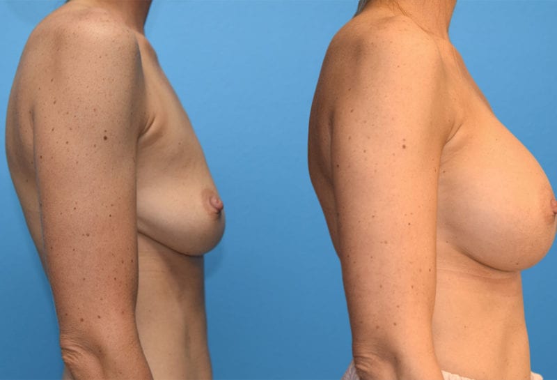 breast augmentation results by dr. maningas at maningas cosmetic surgery in joplin, mo