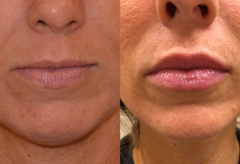 Lip Filler in Joplin, MO at Maningas Cosmetics Surgery