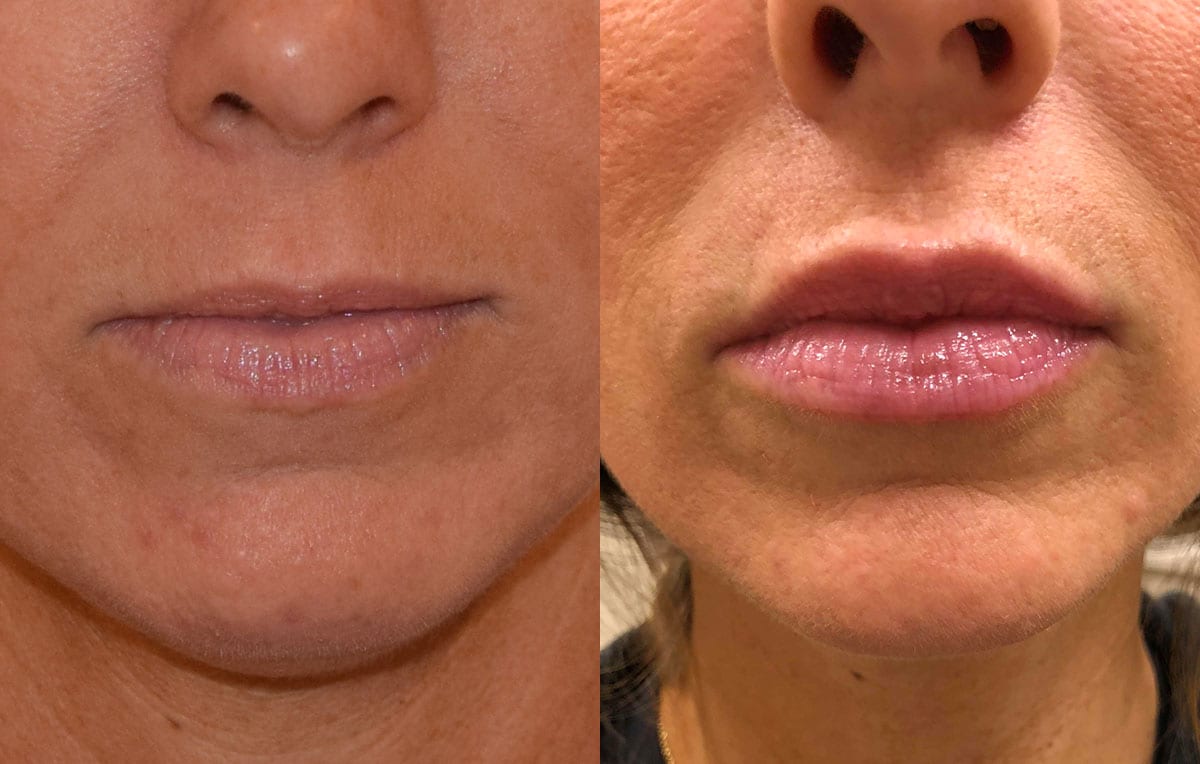 Lip Filler in Joplin, MO at Maningas Cosmetics Surgery