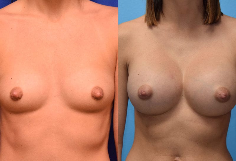 breast augmentation results by dr. maningas at maningas cosmetic surgery in joplin, mo