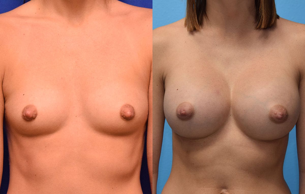 breast augmentation results by dr. maningas at maningas cosmetic surgery in joplin, mo