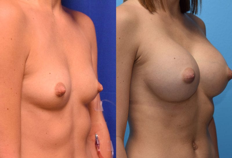 breast augmentation results by dr. maningas at maningas cosmetic surgery in joplin, mo