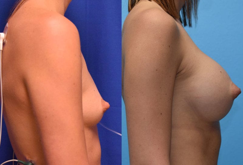 breast augmentation results by dr. maningas at maningas cosmetic surgery in joplin, mo