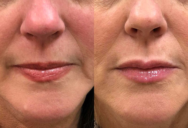 Lip Filler in Joplin, MO at Maningas Cosmetics Surgery