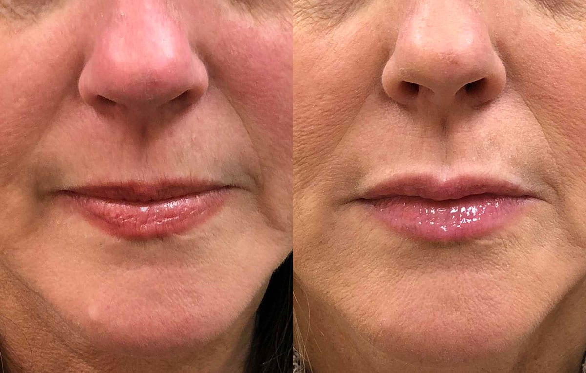 Lip Filler in Joplin, MO at Maningas Cosmetics Surgery