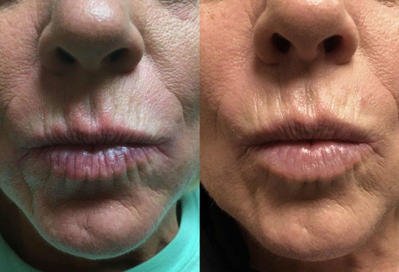 Lip Filler in Joplin, MO at Maningas Cosmetics Surgery