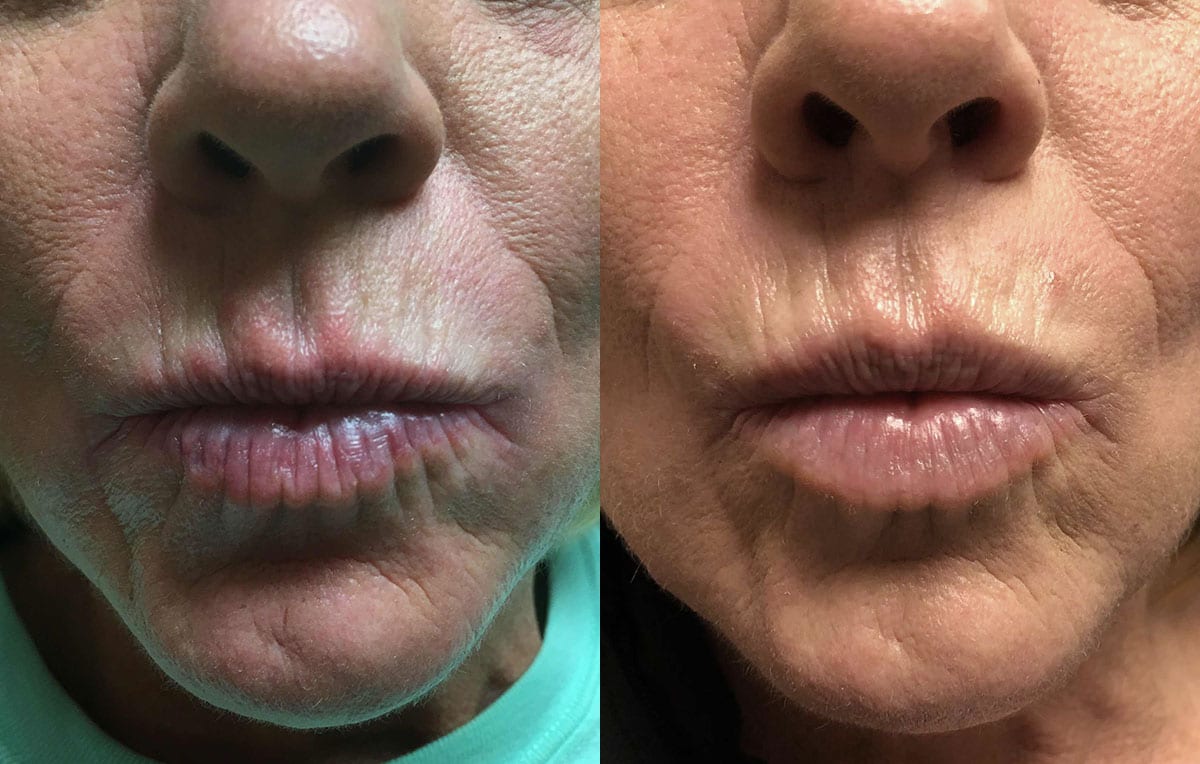 Lip Filler in Joplin, MO at Maningas Cosmetics Surgery