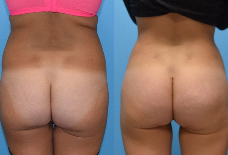 Brazilian Butt Lift by Dr. Maningas at Maningas Cosmetic Surgery in Joplin, MO