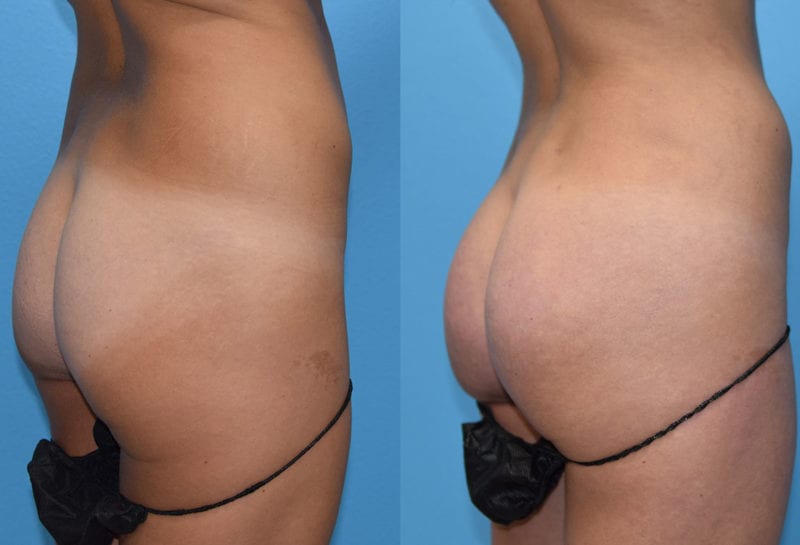 Brazilian Butt Lift by Dr. Maningas at Maningas Cosmetic Surgery in Joplin, MO