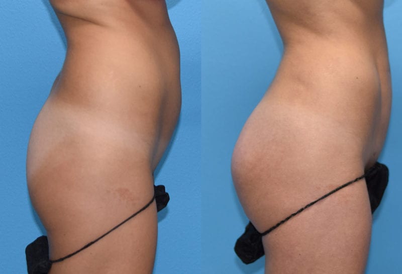 Brazilian Butt Lift by Dr. Maningas at Maningas Cosmetic Surgery in Joplin, MO