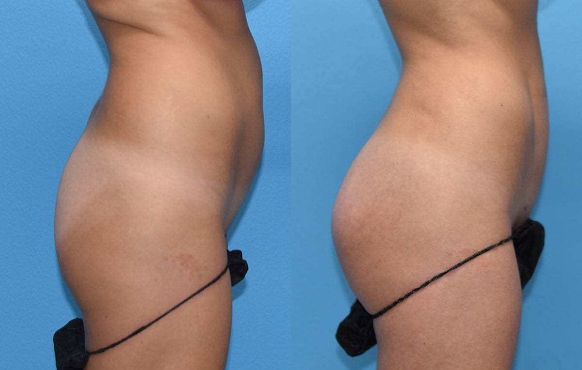 Brazilian Butt Lift by Dr. Maningas at Maningas Cosmetic Surgery in Joplin, MO