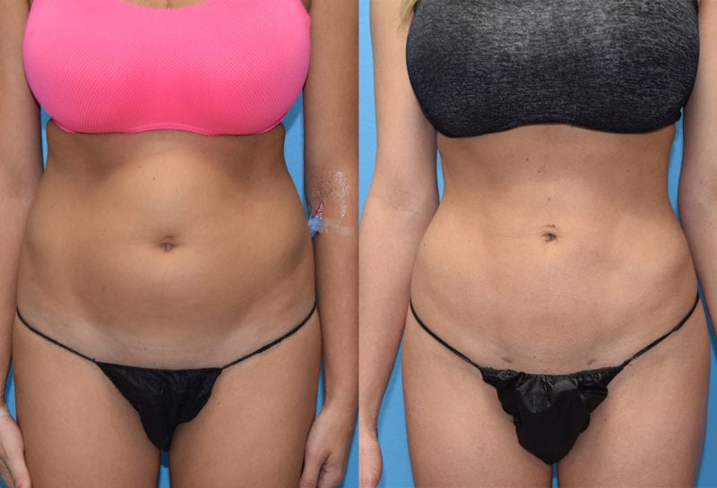 Liposuction Results by Dr. Maningas at Maningas Cosmetic Surgery in Joplin, MO