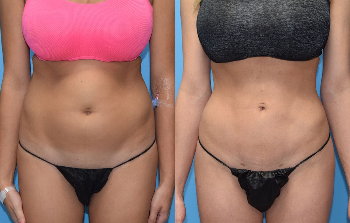 Liposuction Results by Dr. Maningas at Maningas Cosmetic Surgery in Joplin, MO