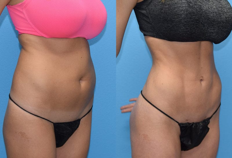 Liposuction Results by Dr. Maningas at Maningas Cosmetic Surgery in Joplin, MO