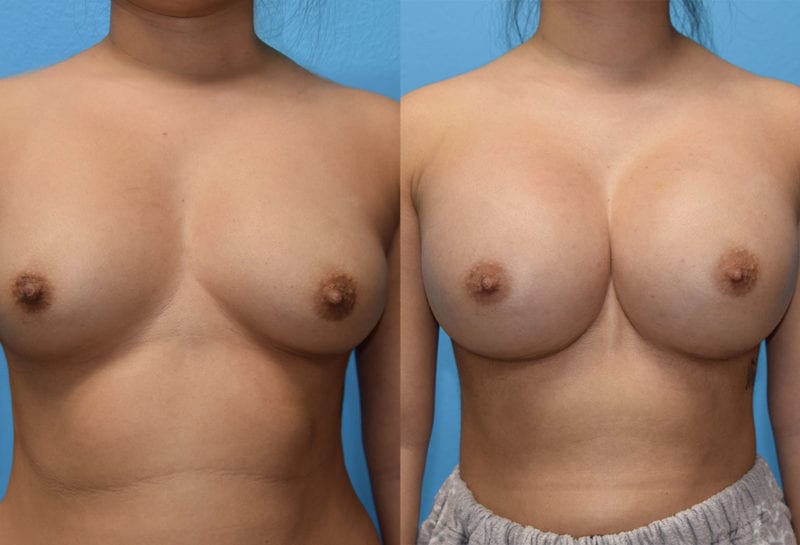 breast augmentation results by dr. maningas at maningas cosmetic surgery in joplin, mo