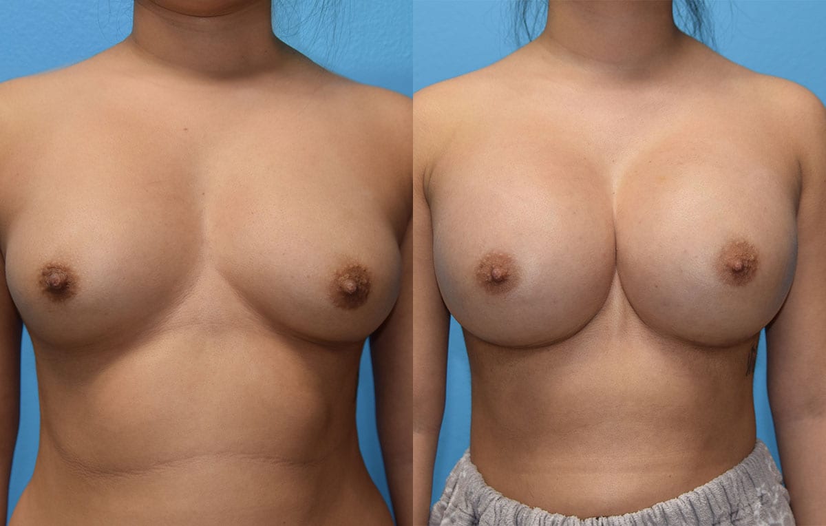 breast augmentation results by dr. maningas at maningas cosmetic surgery in joplin, mo