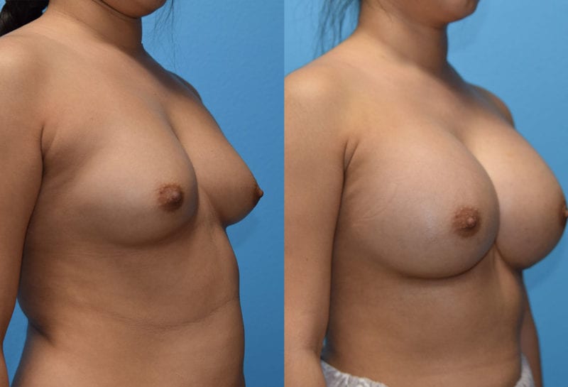 breast augmentation results by dr. maningas at maningas cosmetic surgery in joplin, mo