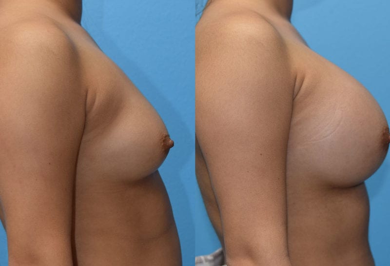 breast augmentation results by dr. maningas at maningas cosmetic surgery in joplin, mo