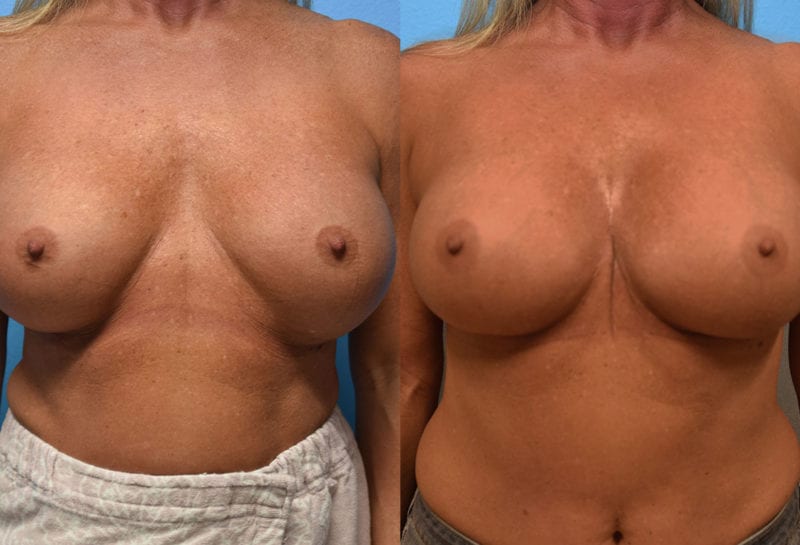 Cosmetic breast revision results by Dr. Maningas at Maningas Cosmetic Surgery in Missouri and Arkansas