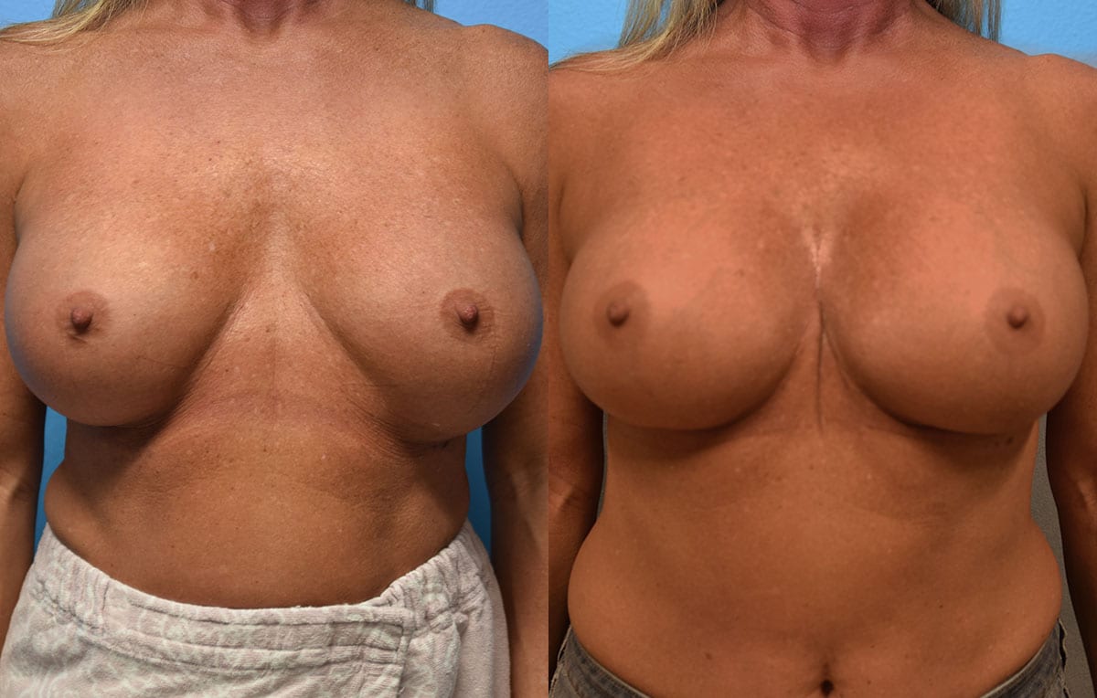 Cosmetic breast revision results by Dr. Maningas at Maningas Cosmetic Surgery in Missouri and Arkansas