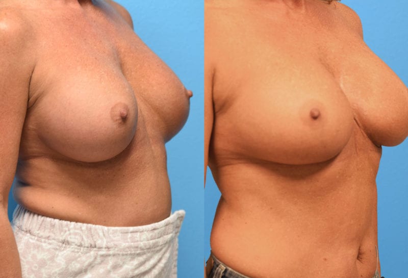 Cosmetic breast revision results by Dr. Maningas at Maningas Cosmetic Surgery in Missouri and Arkansas