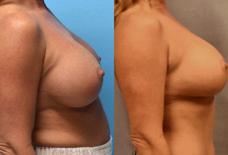 Cosmetic breast revision results by Dr. Maningas at Maningas Cosmetic Surgery in Missouri and Arkansas