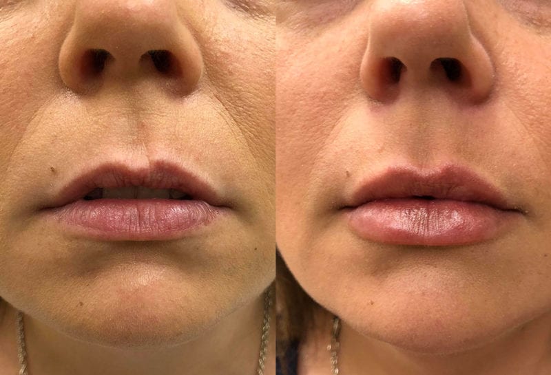 Lip Filler in Joplin, MO at Maningas Cosmetics Surgery