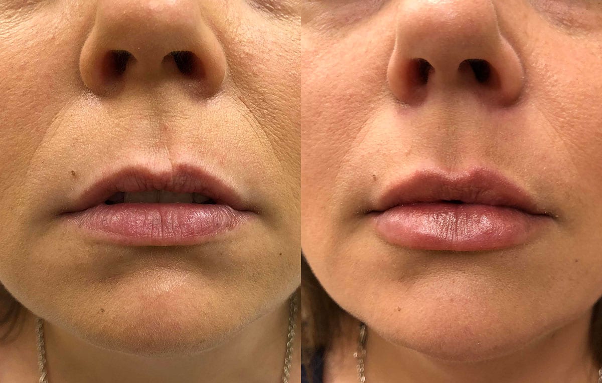 Lip Filler in Joplin, MO at Maningas Cosmetics Surgery