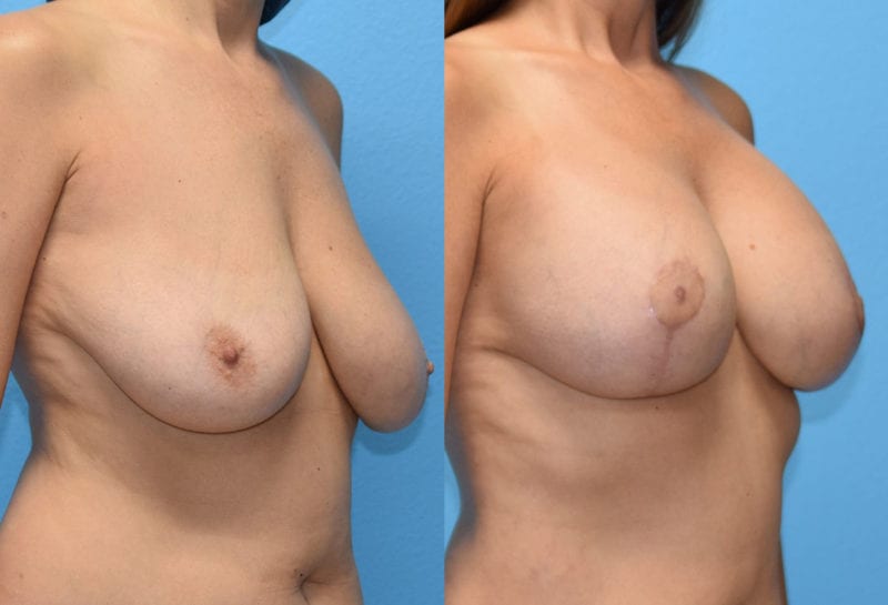 Breast Lift with Implant results by Dr. Maningas at Maningas Cosmetic Surgery in Missouri and Arkansas