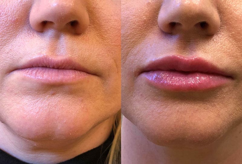 Lip Filler in Joplin, MO at Maningas Cosmetics Surgery