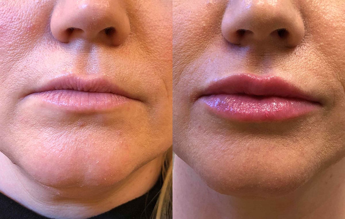 Lip Filler in Joplin, MO at Maningas Cosmetics Surgery